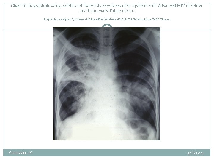 Chest Radiograph showing middle and lower lobe involvement in a patient with Advanced HIV