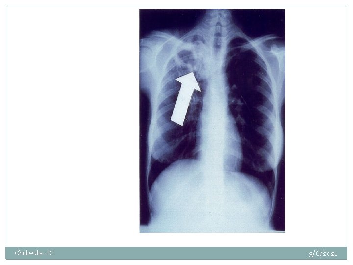 Arrow points to cavity in patient's right upper lobe --typical finding in patient with