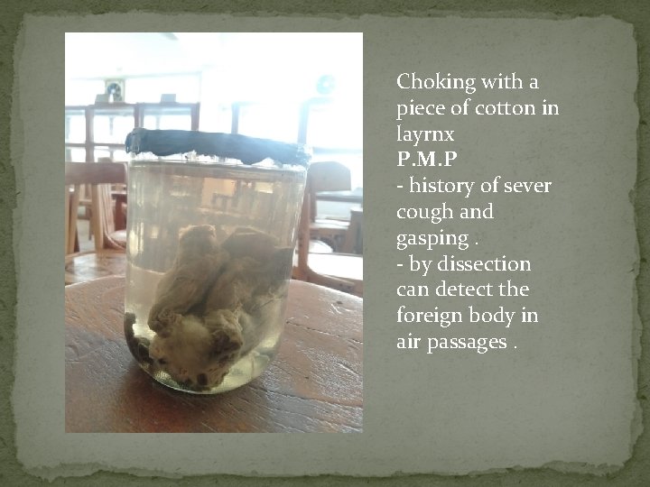 Choking with a piece of cotton in layrnx P. M. P - history of