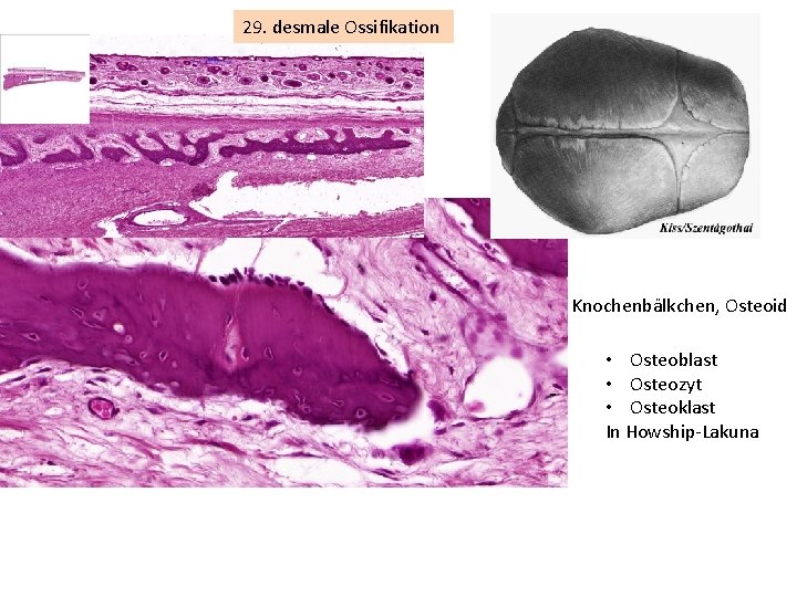 29. desmale Ossifikation Knochenbälkchen, Osteoid • Osteoblast • Osteozyt • Osteoklast In Howship-Lakuna 