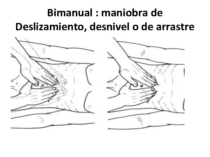 Bimanual : maniobra de Deslizamiento, desnivel o de arrastre 