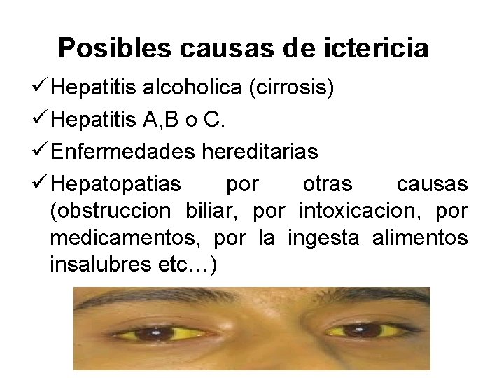 Posibles causas de ictericia ü Hepatitis alcoholica (cirrosis) ü Hepatitis A, B o C. Posibles causas de ictericia ü Hepatitis alcoholica (cirrosis) ü Hepatitis A, B o C.