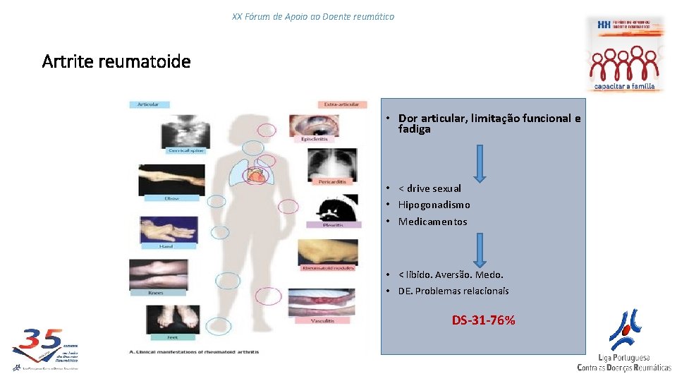 XX Fórum de Apoio ao Doente reumático Artrite reumatoide • Dor articular, limitação funcional