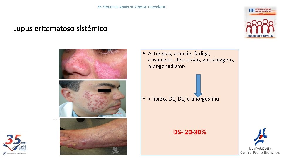 XX Fórum de Apoio ao Doente reumático Lupus eritematoso sistémico • Artralgias, anemia, fadiga,
