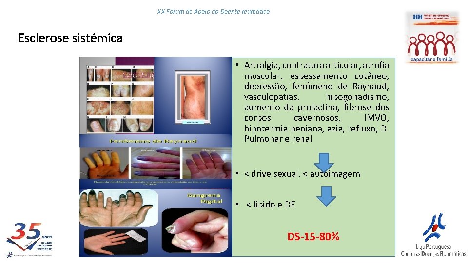 XX Fórum de Apoio ao Doente reumático Esclerose sistémica • Artralgia, contratura articular, atrofia