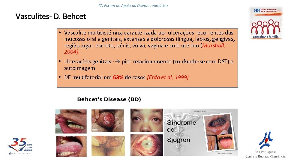 XX Fórum de Apoio ao Doente reumático Vasculites- D. Behcet • Vasculite multisistémica caracterizada