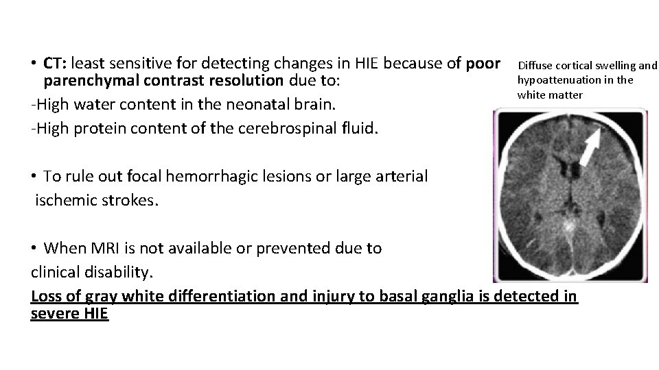  • CT: least sensitive for detecting changes in HIE because of poor parenchymal