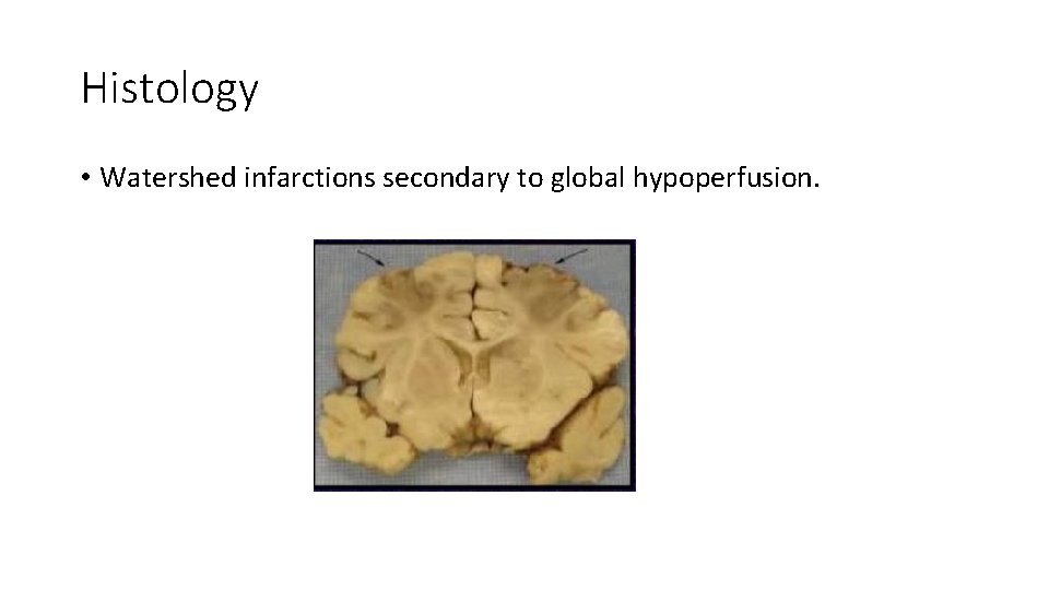 Histology • Watershed infarctions secondary to global hypoperfusion. 