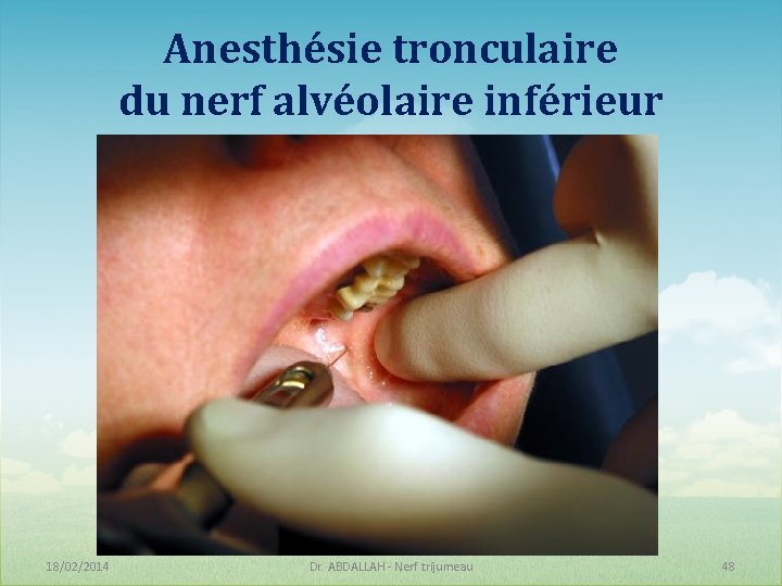 Anesthésie tronculaire du nerf alvéolaire inférieur 18/02/2014 Dr. ABDALLAH - Nerf trijumeau 48 