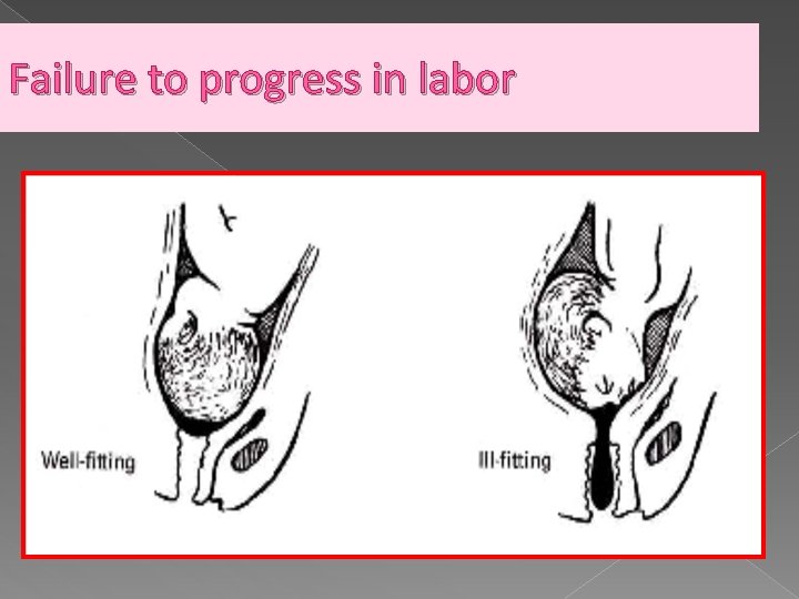 Failure to progress in labor 
