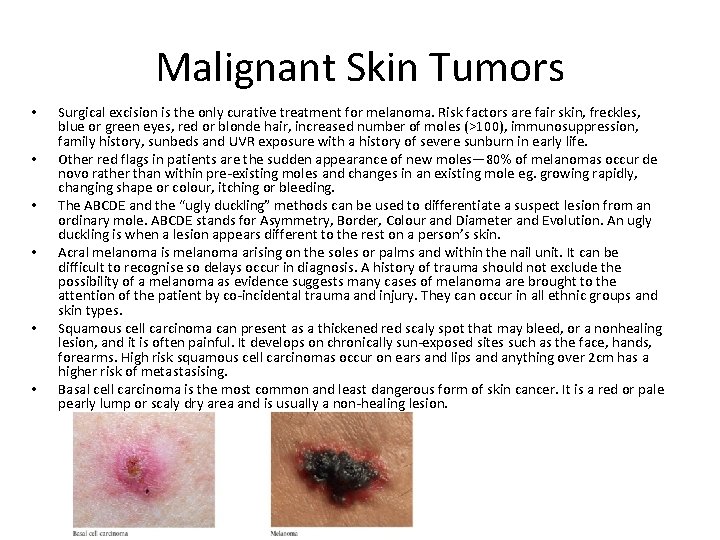 Malignant Skin Tumors • • • Surgical excision is the only curative treatment for
