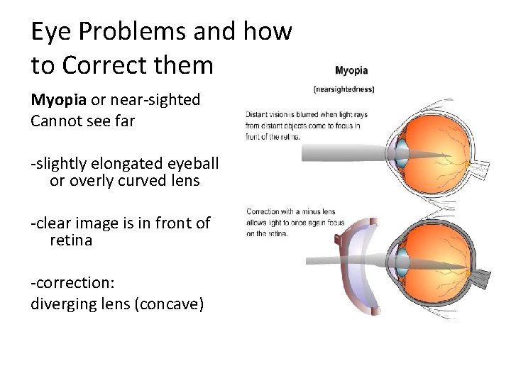 Eye Problems and how to Correct them Myopia or near-sighted Cannot see far -slightly