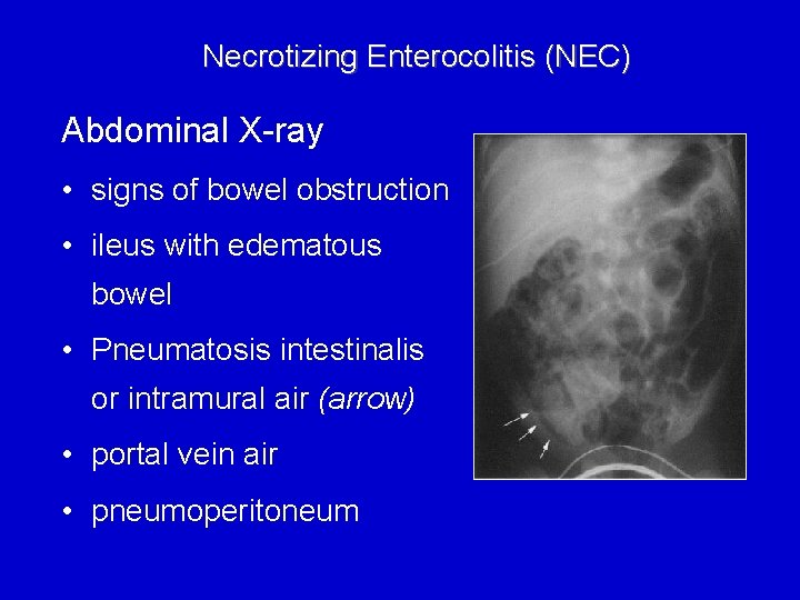 Necrotizing Enterocolitis (NEC) Abdominal X-ray • signs of bowel obstruction • ileus with edematous