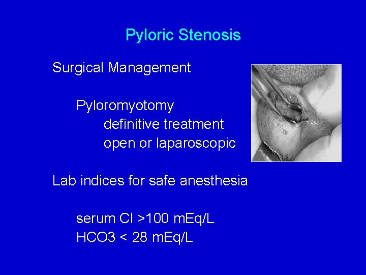 Pyloric Stenosis Surgical Management Pyloromyotomy definitive treatment open or laparoscopic Lab indices for safe