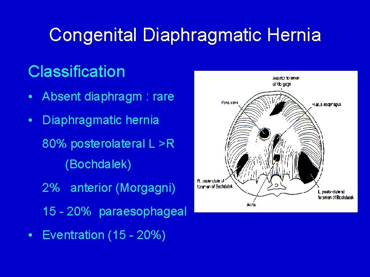 Congenital Diaphragmatic Hernia Classification • Absent diaphragm : rare • Diaphragmatic hernia 80% posterolateral