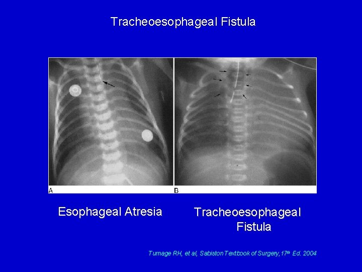 Tracheoesophageal Fistula Esophageal Atresia Tracheoesophageal Fistula Turnage RH, et al, Sabiston Textbook of Surgery,