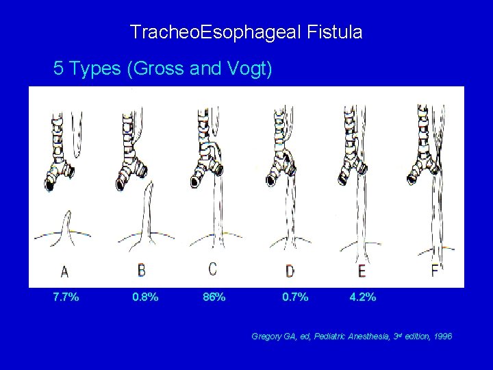 Tracheo. Esophageal Fistula 5 Types (Gross and Vogt) 7. 7% 0. 8% 86% 0.