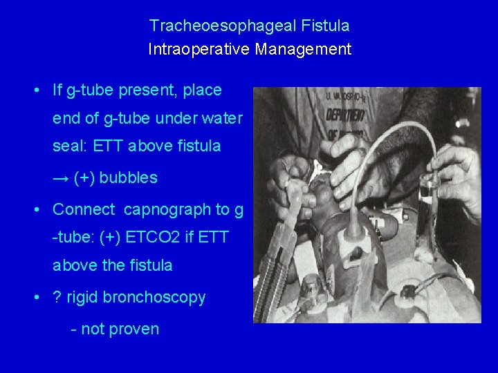 Tracheoesophageal Fistula Intraoperative Management • If g-tube present, place end of g-tube under water