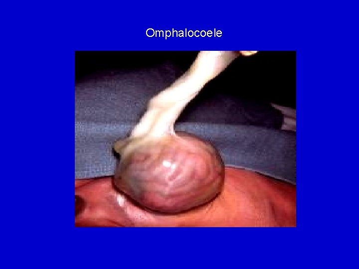 Omphalocoele 