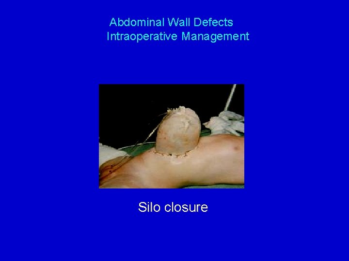 Abdominal Wall Defects Intraoperative Management Silo closure 