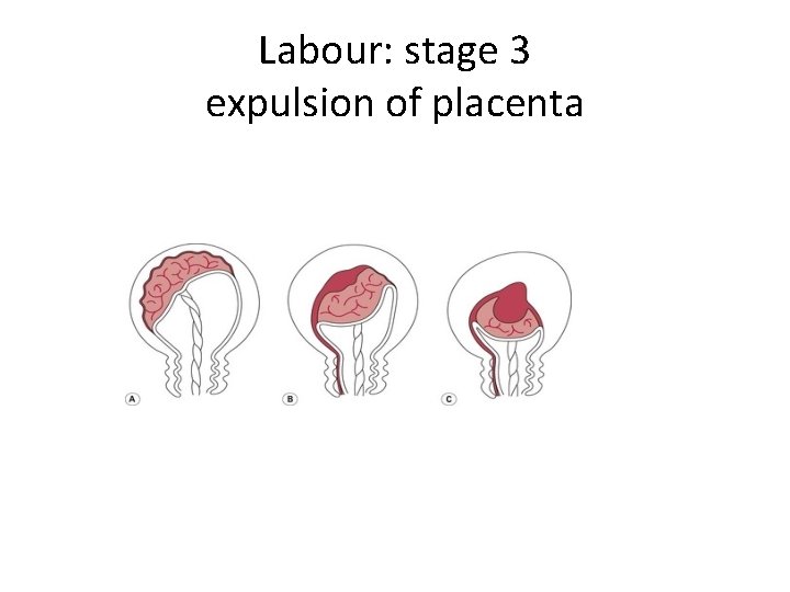 Labour: stage 3 expulsion of placenta 