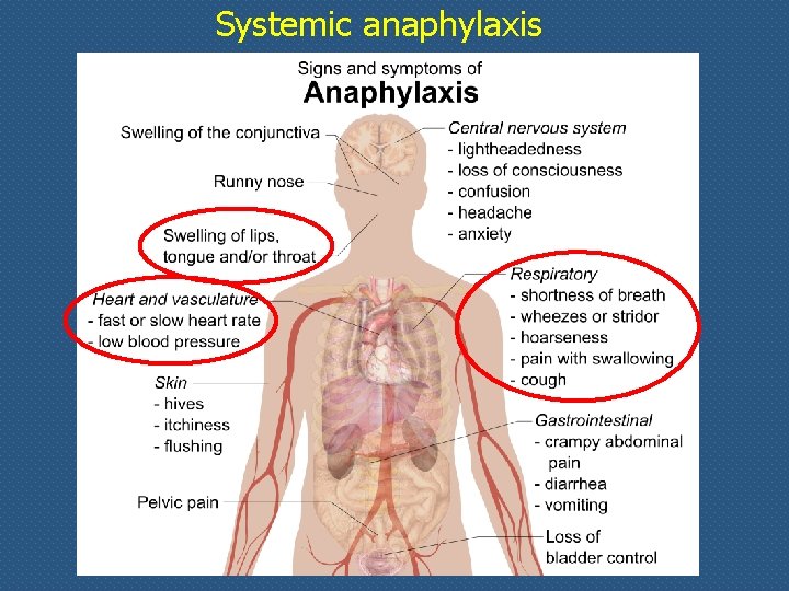 Systemic anaphylaxis 