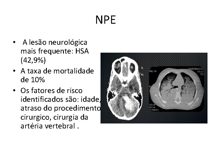 NPE • A lesão neurológica mais frequente: HSA (42, 9%) • A taxa de