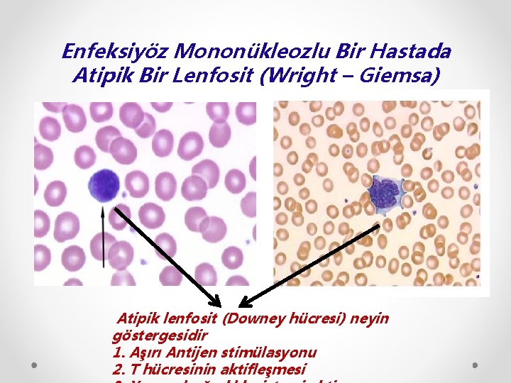Enfeksiyöz Mononükleozlu Bir Hastada Atipik Bir Lenfosit (Wright – Giemsa) Atipik lenfosit (Downey hücresi)