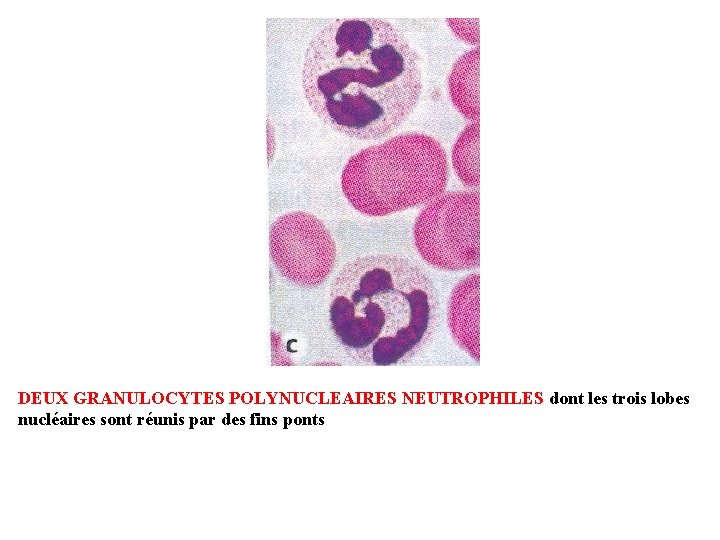 DEUX GRANULOCYTES POLYNUCLEAIRES NEUTROPHILES dont les trois lobes nucléaires sont réunis par des fins
