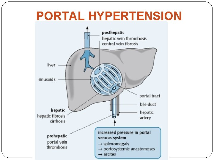 PORTAL HYPERTENSION 