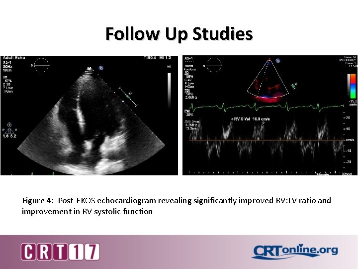 Follow Up Studies Figure 4: Post-EKOS echocardiogram revealing significantly improved RV: LV ratio and