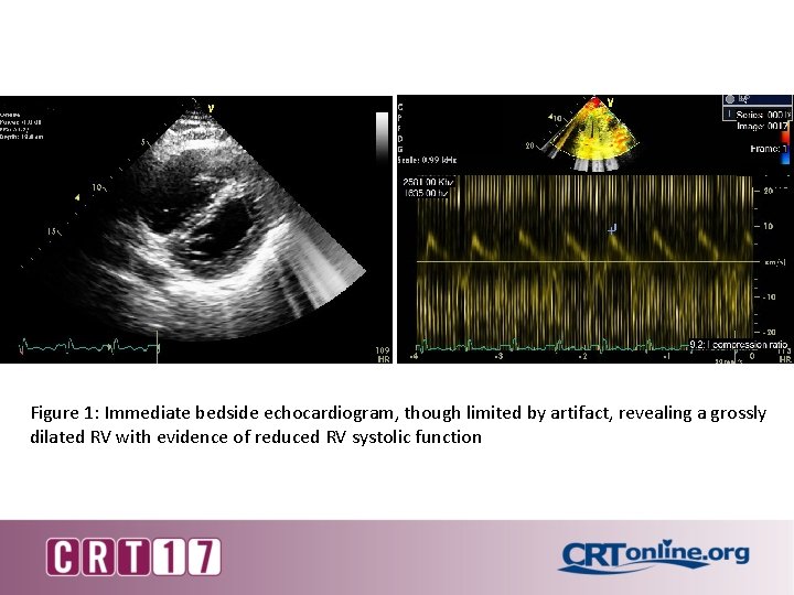 Figure 1: Immediate bedside echocardiogram, though limited by artifact, revealing a grossly dilated RV