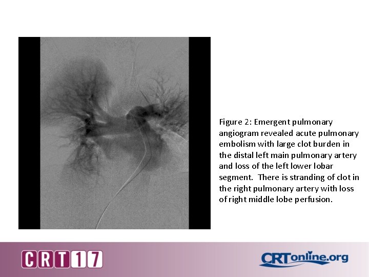 Figure 2: Emergent pulmonary angiogram revealed acute pulmonary embolism with large clot burden in