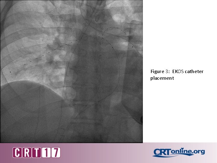 Figure 3: EKOS catheter placement 