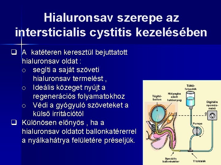 Hialuronsav szerepe az intersticialis cystitis kezelésében q A katéteren keresztül bejuttatott hialuronsav oldat :