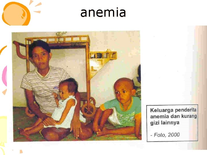 anemia 