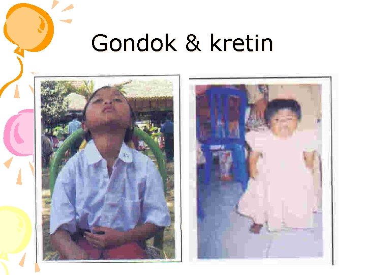 Gondok & kretin 