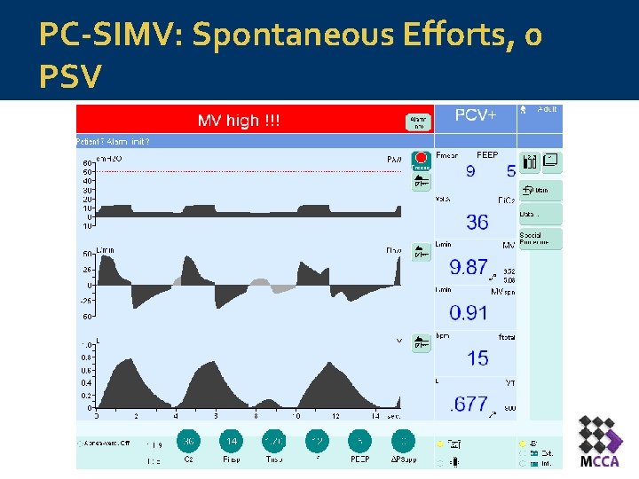 PC-SIMV: Spontaneous Efforts, 0 PSV PC-SIMV: Spontaneous Efforts, 0 PSV