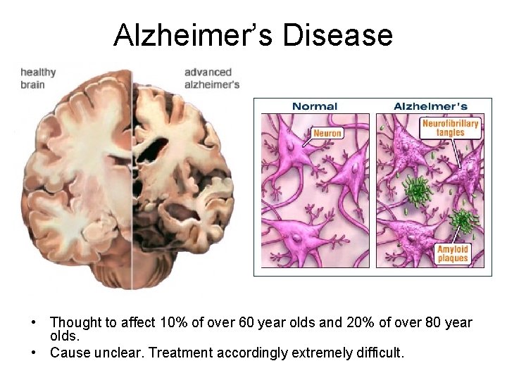 Alzheimer’s Disease • Thought to affect 10% of over 60 year olds and 20%