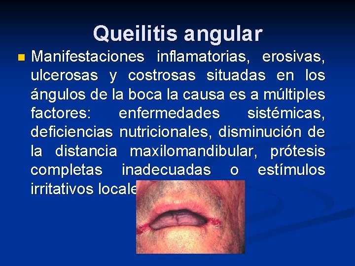 Queilitis angular n Manifestaciones inflamatorias, erosivas, ulcerosas y costrosas situadas en los ángulos de