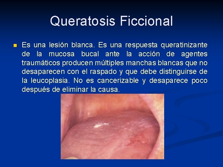 Queratosis Ficcional n Es una lesión blanca. Es una respuesta queratinizante de la mucosa