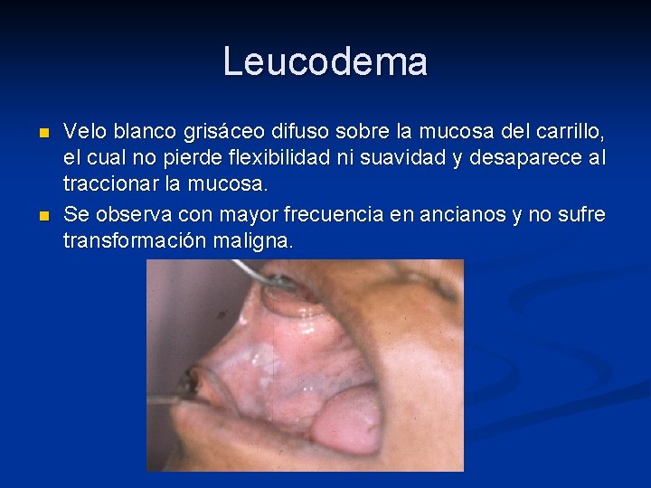 Leucodema n n Velo blanco grisáceo difuso sobre la mucosa del carrillo, el cual