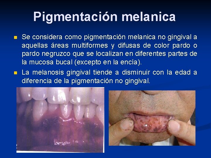 Pigmentación melanica n n Se considera como pigmentación melanica no gingival a aquellas áreas