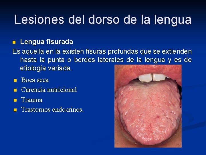 Lesiones del dorso de la lengua Lengua fisurada Es aquella en la existen fisuras