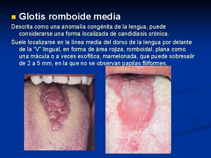 n Glotis romboide media Descrita como una anomalía congénita de la lengua, puede considerarse