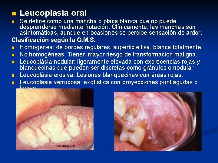 n Leucoplasia oral Se define como una mancha o placa blanca que no puede