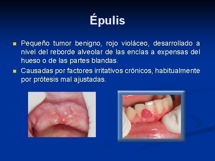 Épulis n n Pequeño tumor benigno, rojo violáceo, desarrollado a nivel del reborde alveolar