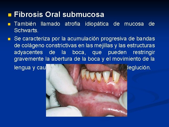 n Fibrosis Oral submucosa n También llamado atrofia idiopática de mucosa de Schwarts. Se
