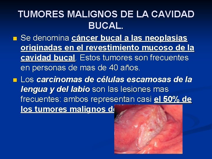 TUMORES MALIGNOS DE LA CAVIDAD BUCAL. n n Se denomina cáncer bucal a las