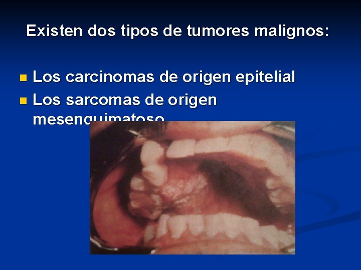 Existen dos tipos de tumores malignos: Los carcinomas de origen epitelial n Los sarcomas